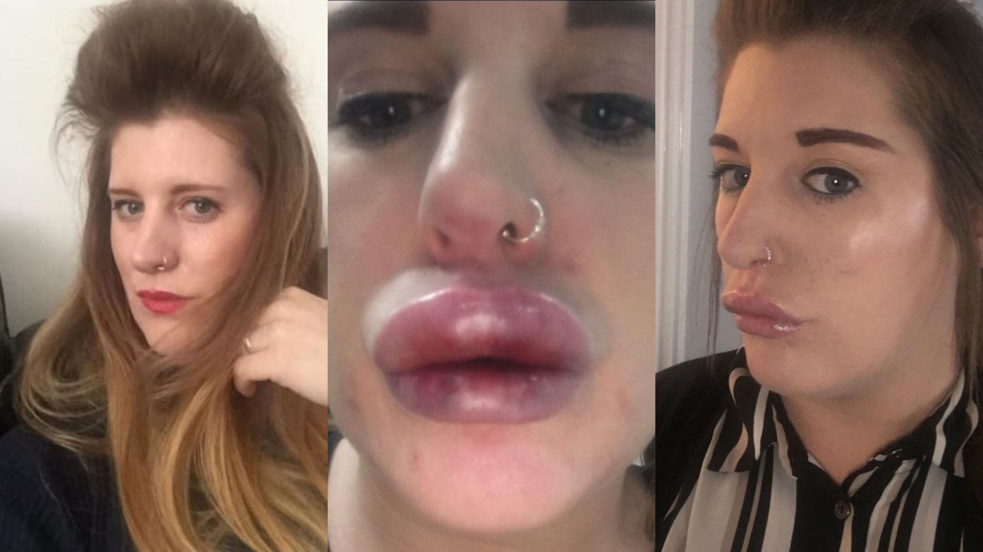 Kelly myślała, że zaoszczędzi na zabiegu powiększania ust 