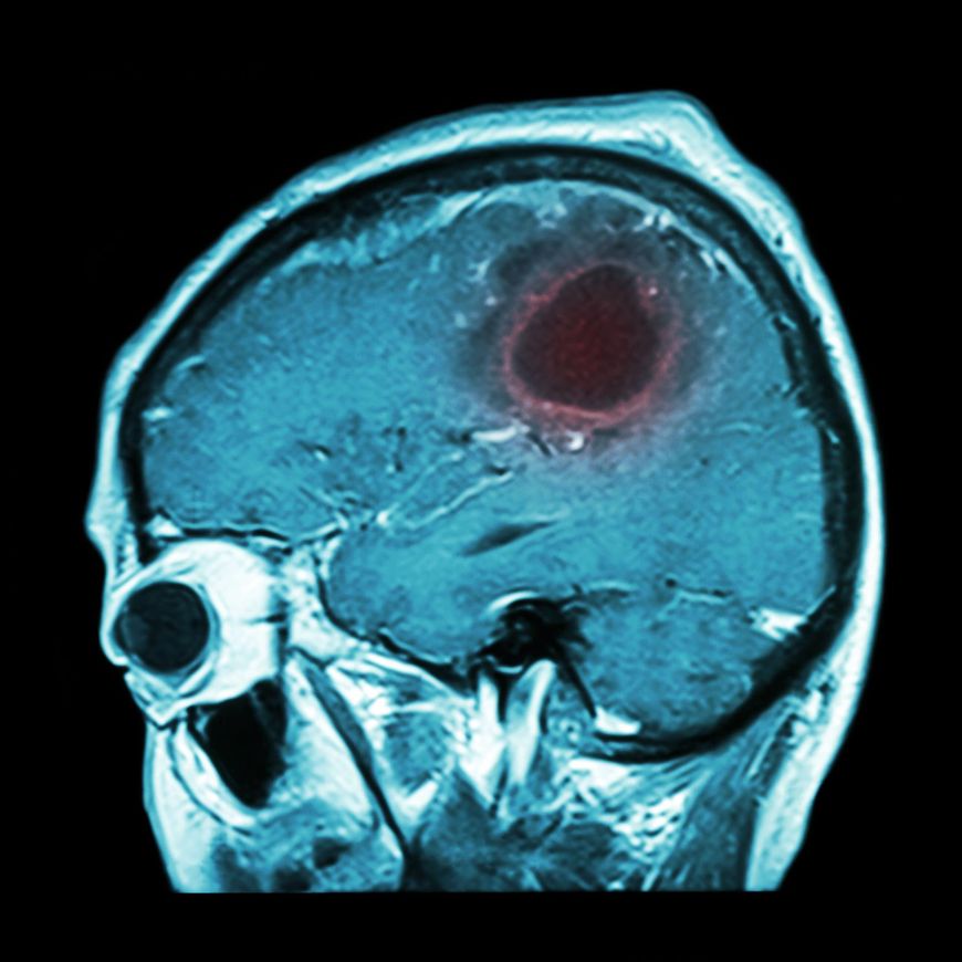 Objawy ogólne spowodowane są wzrostem ciśnienia wewnątrz czaszkowego