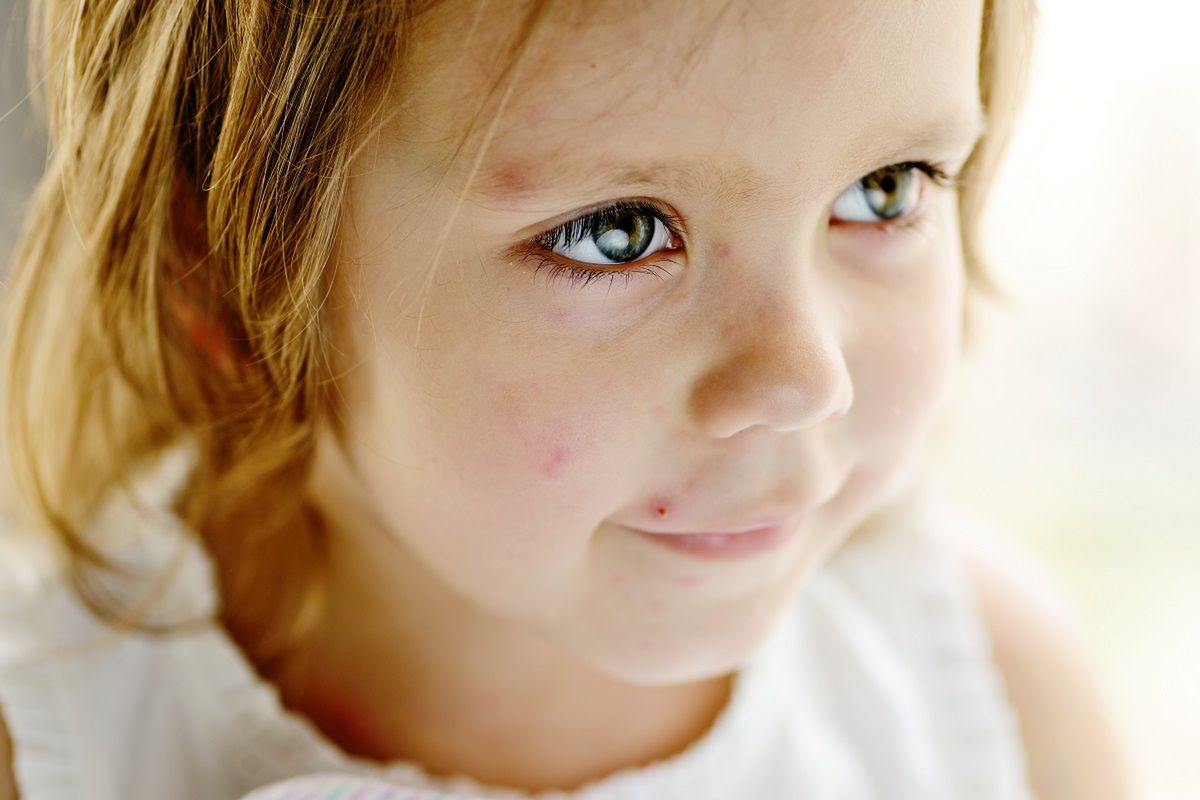 Ospa party – realne zagrożenie czy metoda na przestraszenie rodziców