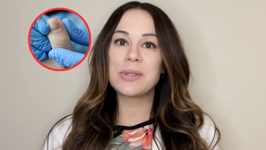 Rak widocznych na paznokciach. Dermatolog błaga, by go nie ignorować