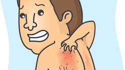 Swędząca skóra - czym jest swędzenie, przyczyny, alergie, leczenie, sposoby na świąd