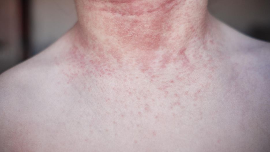 Zapomniana choroba dziecięca powróciła? Te liczby niepokoją