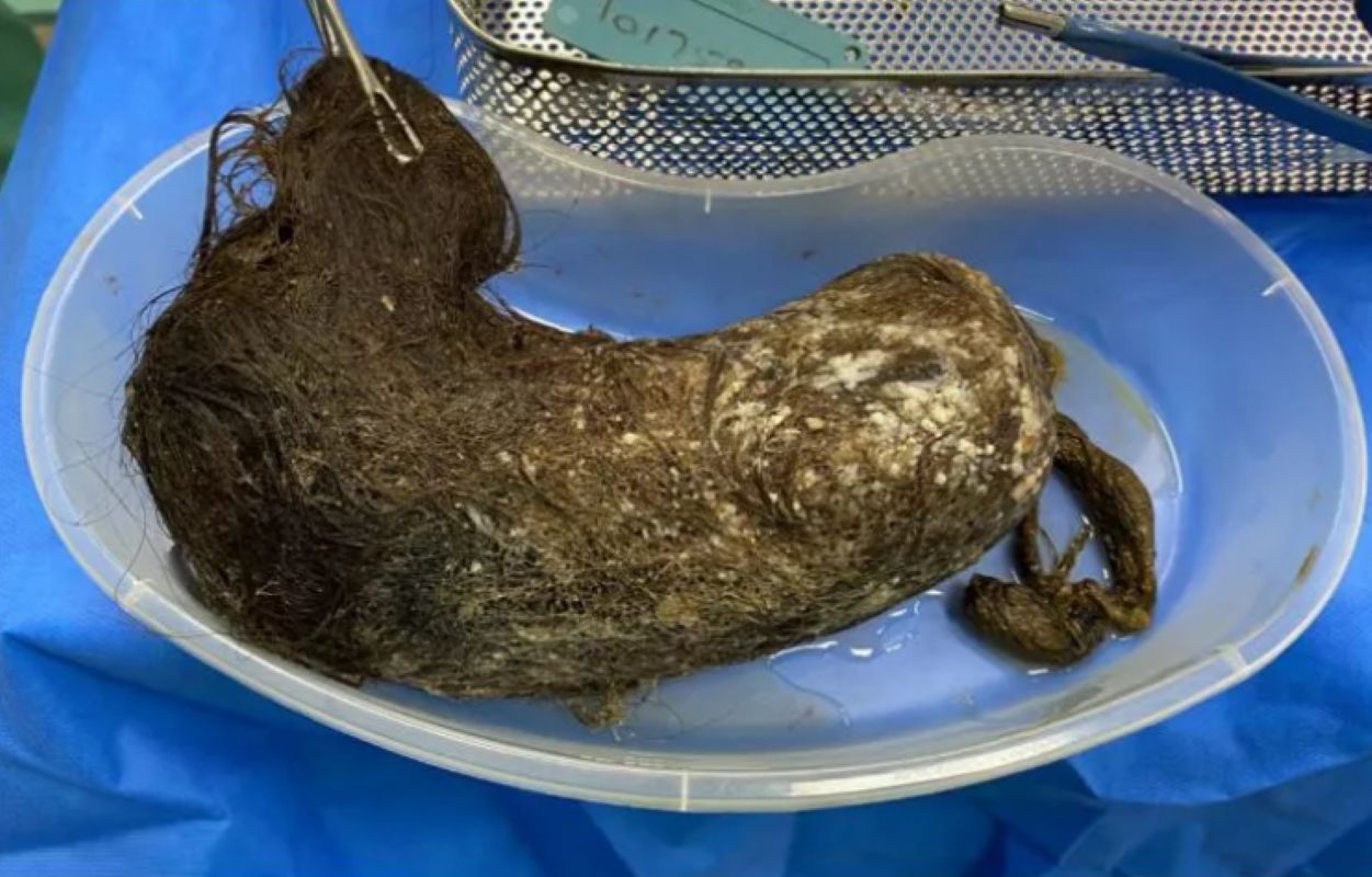 Kula włosów w żołądku nastolatki