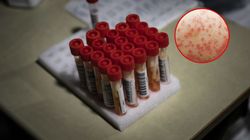 Małpia ospa. Testu nie zrobisz na własną rękę. Jak sprawdzić zakażenie?