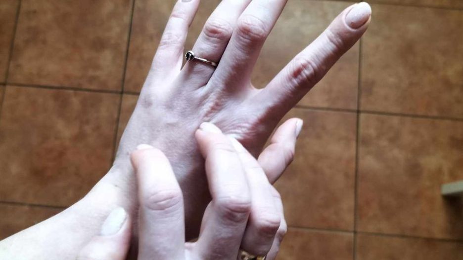 Swędzące dłonie w ciąży? Nie bagatelizuj!