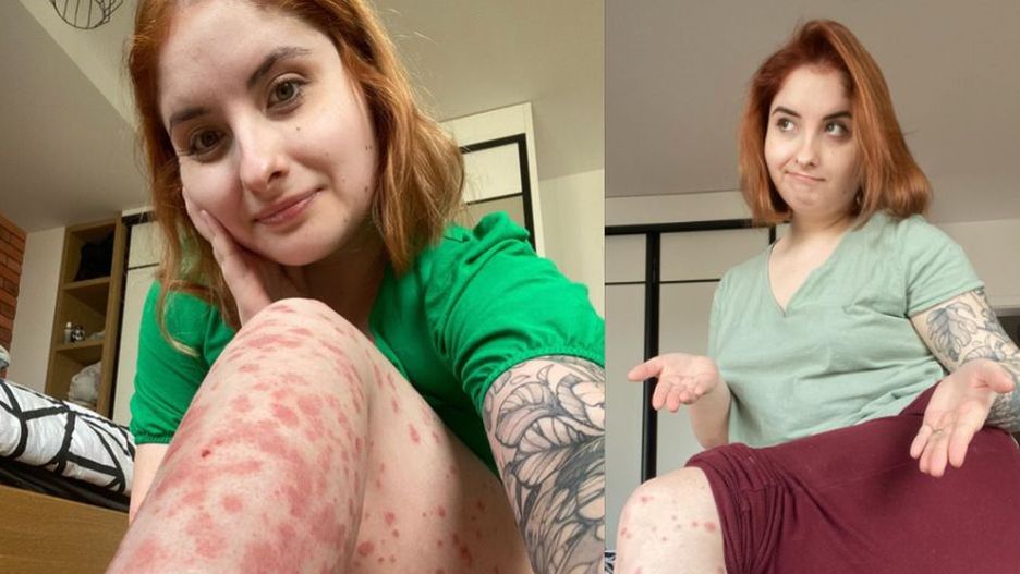 Mama choruje na łuszczycę. Wiele razy słyszała, że jest "nieestetyczna"