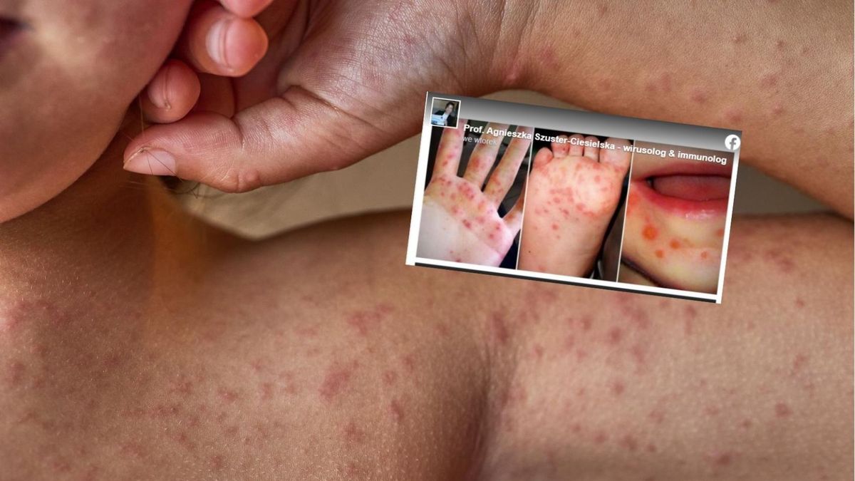 HMFS charakteryzuje się występowaniem wykwitów pęcherzykowych i plamisto-grudkowych na stopach, dłoniach oraz w okolicach ust