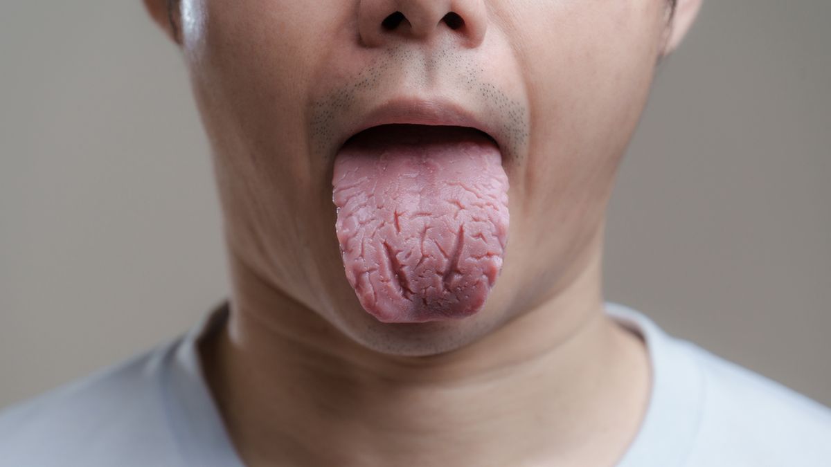 Język mosznowy jest najczęściej skutkiem niedoboru witamin w organizmie.