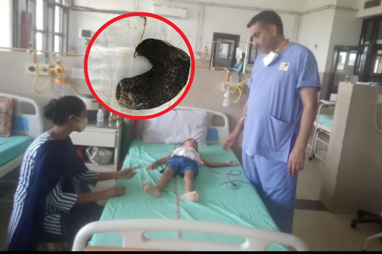 Trichobezoar odkryty w żołądku pięciolatki