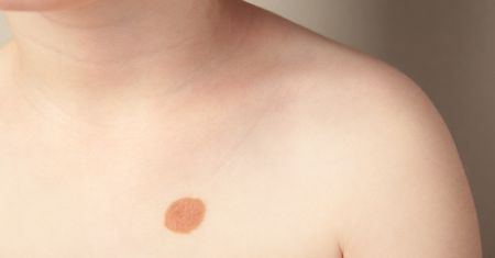 Znamię u dziecka – rodzaje, przyczyny i postępowanie