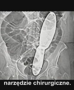 Rażące niechlujstwo lekarzy prawie ją zabiło