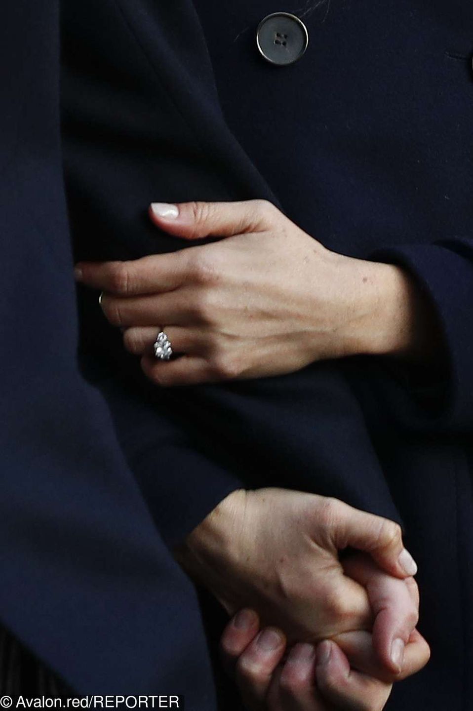 Meghan Markle ma chorobę genetyczną