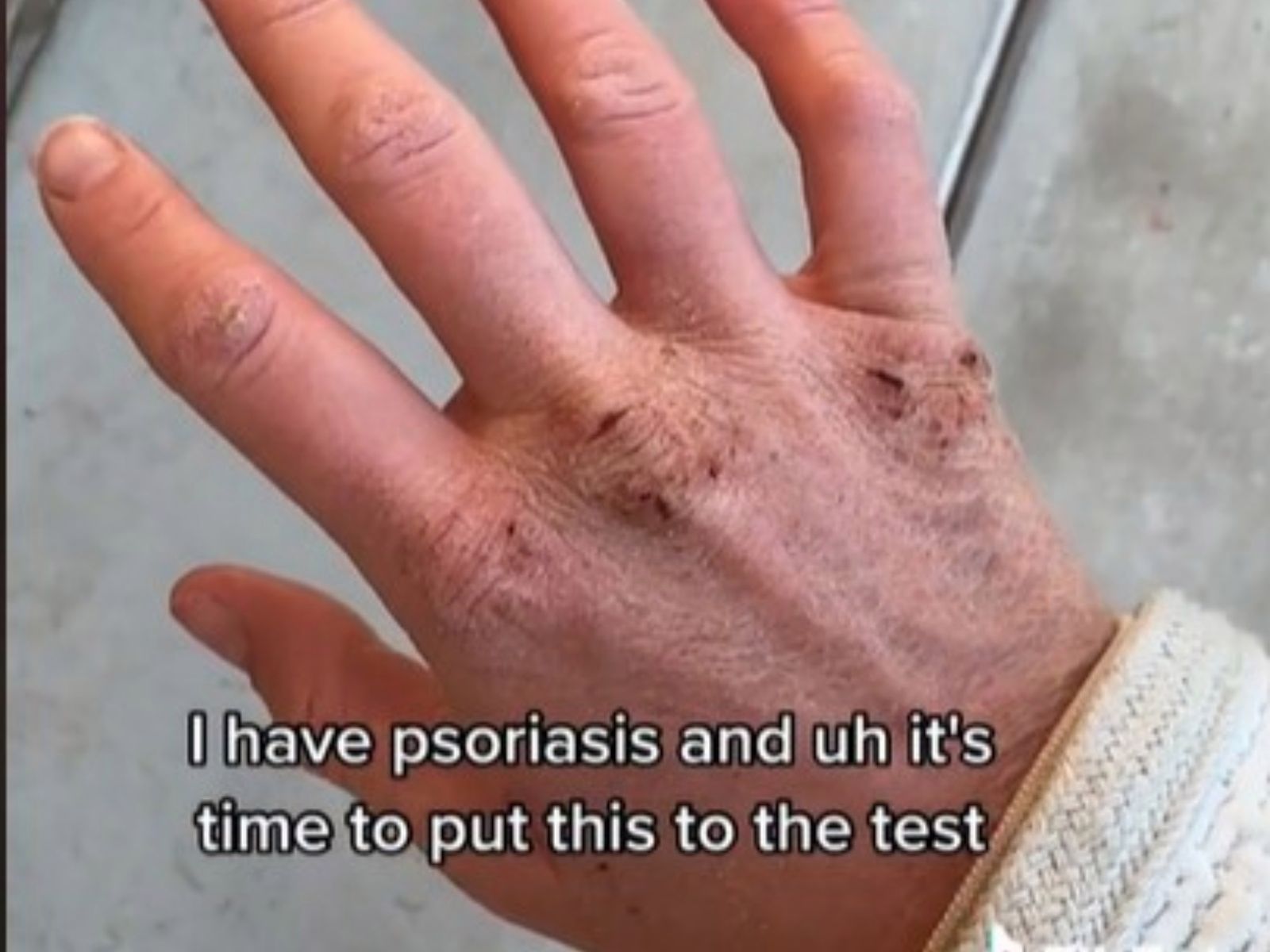 Mleko z piersi uratowało jej dłonie.