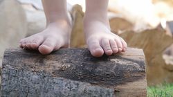 Płaskostopie u dzieci - objawy, przyczyny, leczenie i zapobieganie