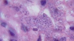 Leishmania - co to jest, objawy, leczenie