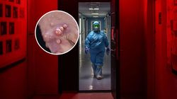 Wysypka przy małpiej ospie. Tak odróżnisz ją od innych chorób zakaźnych