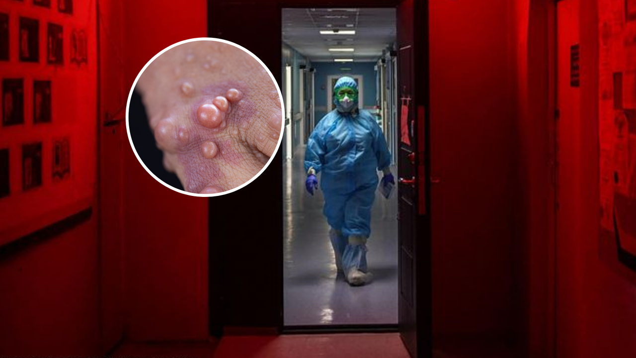 Wysypka przy małpiej ospie. Tak odróżnisz ją od innych chorób zakaźnych
