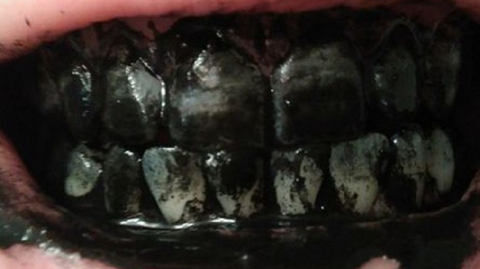 Przez 10 dni myłam zęby węglem aktywowanym. Jak to wpłynęło na ich wygląd?