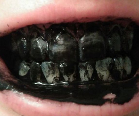 Przez 10 dni myłam zęby węglem aktywowanym. Jak to wpłynęło na ich wygląd?