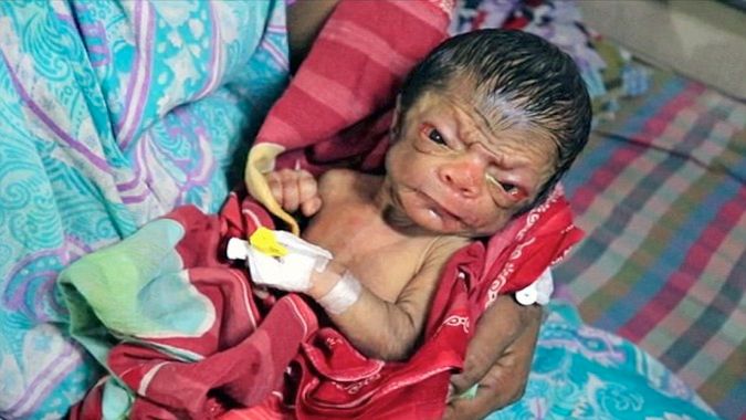 Progeria prawdopodobnie przyczyną tego, że niemowlę wygląda jak staruszek