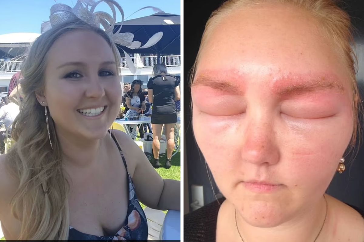 Kosmetyczka nie zapytała klientki o potencjalne alergie