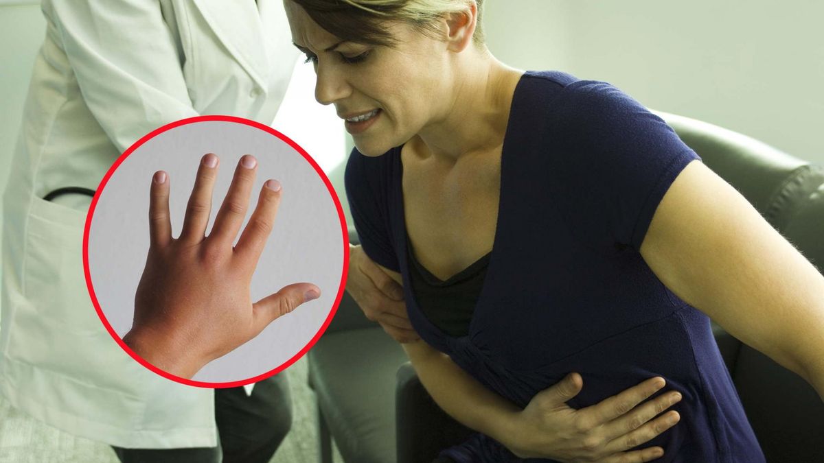 Zwróć uwagę na dłonie, to znak, że choroba jest zaawansowana