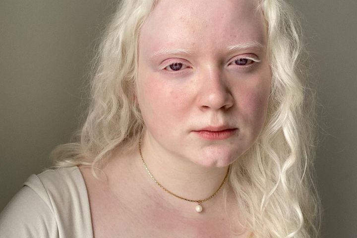 Oceanne w mediach społecznościowych edukuje społeczeństwo na temat albinizmu