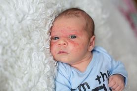 Atopowe zapalenie skóry niemowląt. Jak leczyć azs u niemowlaka?