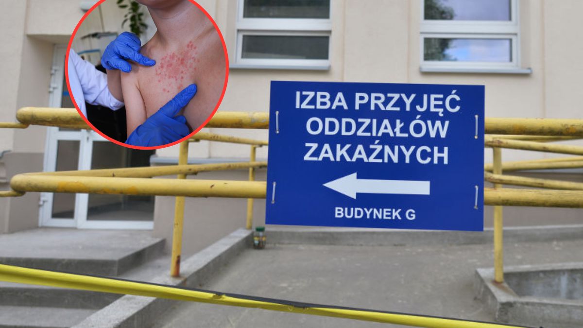 Liczba zachorowań na odrę rośnie