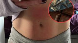 Lekarze myśleli, że ma świerzb. Okazało się, że to nietolerancja histaminy