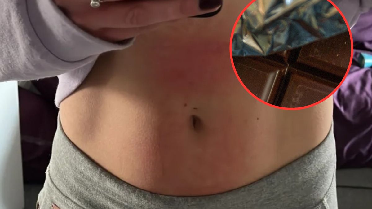 Lekarze mówili Lucy, że to świerzb