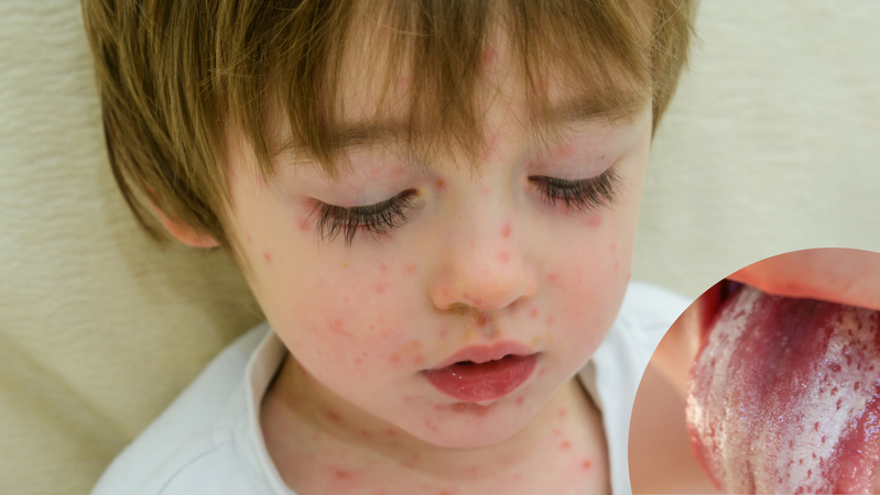 Na bostonkę najczęściej chorują przedszkolaki