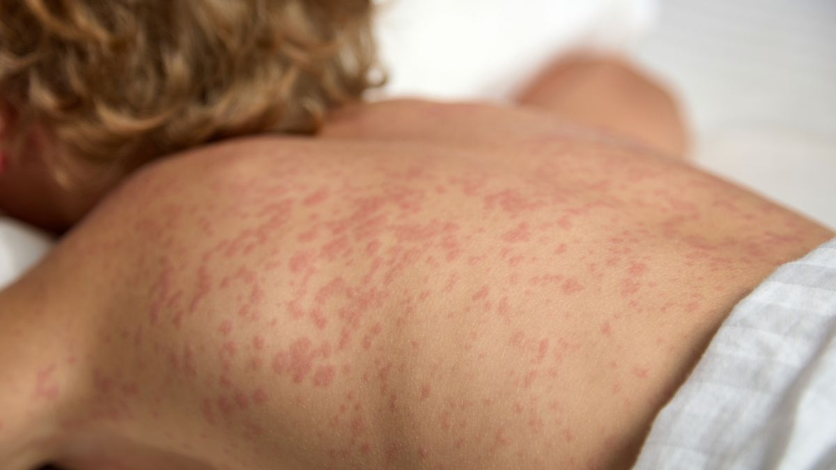 Mastocytoza skórna zwykle przyjmuje postać pokrzywki barwnikowej