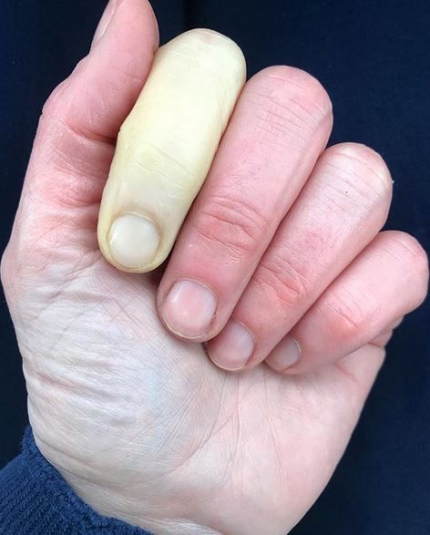 Jenni ma problemy z krążeniem krwi