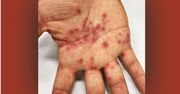 Nietypowe plamy na dłoniach mogą świadczyć o zakażeniu wirusem opryszczki