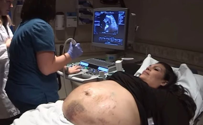 Kobieta zauważyła siniaki na ciążowym brzuchu