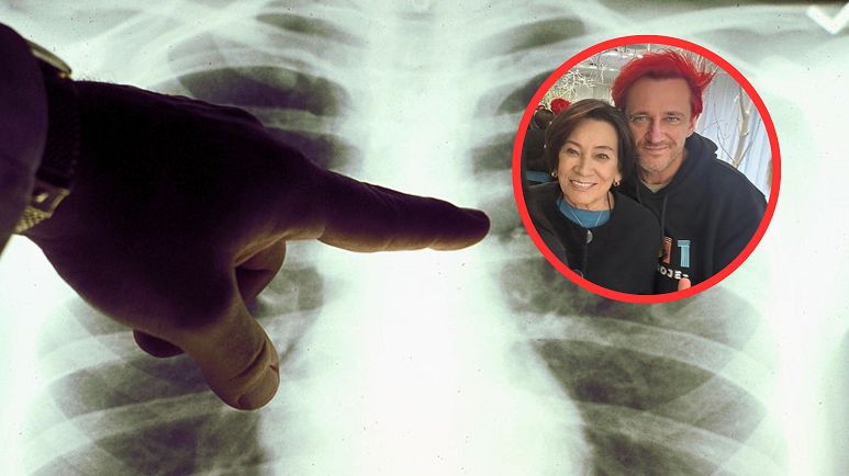 Grażyna Wiśniewska ma raka płuca. Takie są jego objawy