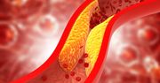 Hipercholesterolemia - ryzyko związane z wysokim poziomem cholesterolu. Jak obniżyć cholesterol?