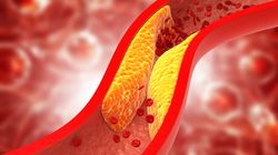 Hipercholesterolemia - ryzyko związane z wysokim poziomem cholesterolu. Jak obniżyć cholesterol?