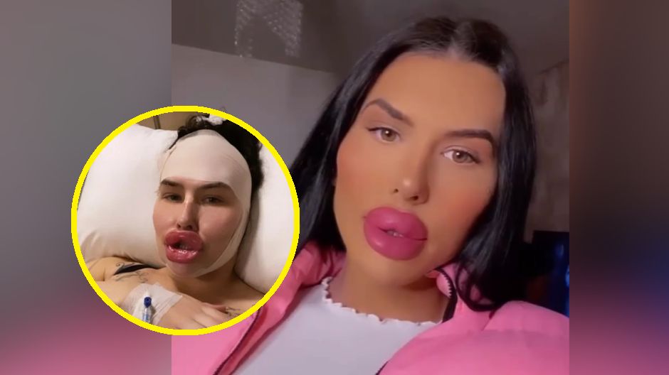 Była o krok od śmierci. Pperacja plastyczna doprowadziła do groźnej infekcji