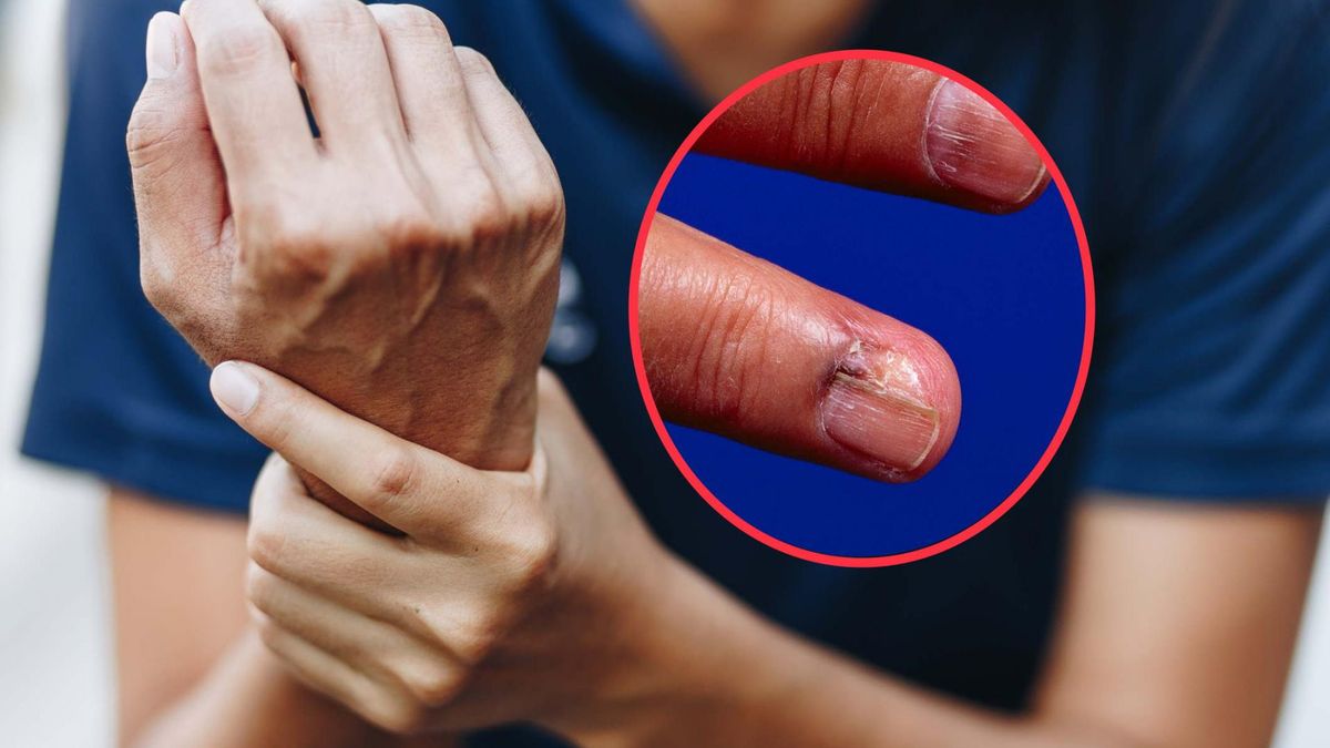 Czerniak paznokcia nie zawsze daje typowe objawy, dlatego łatwo go pomylić np. z infekcją grzybiczą