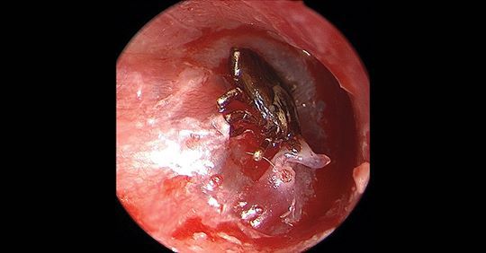 Wewnątrz ucha dziecka znaleziono kleszcza