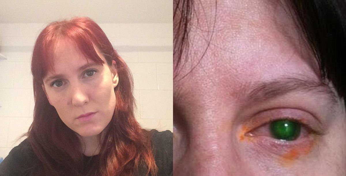 Kobieta przez 20 min pływała w basenie. Zaczęło boleć ją oko