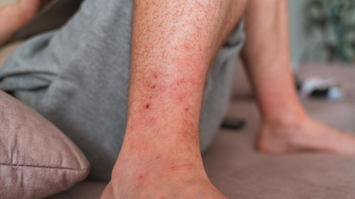 Jakie objawy dają podwyższone d-dimery?