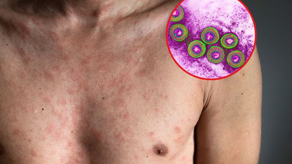 12-krotny wzrost zachorowań. Tak źle nie było od dziesiątek lat