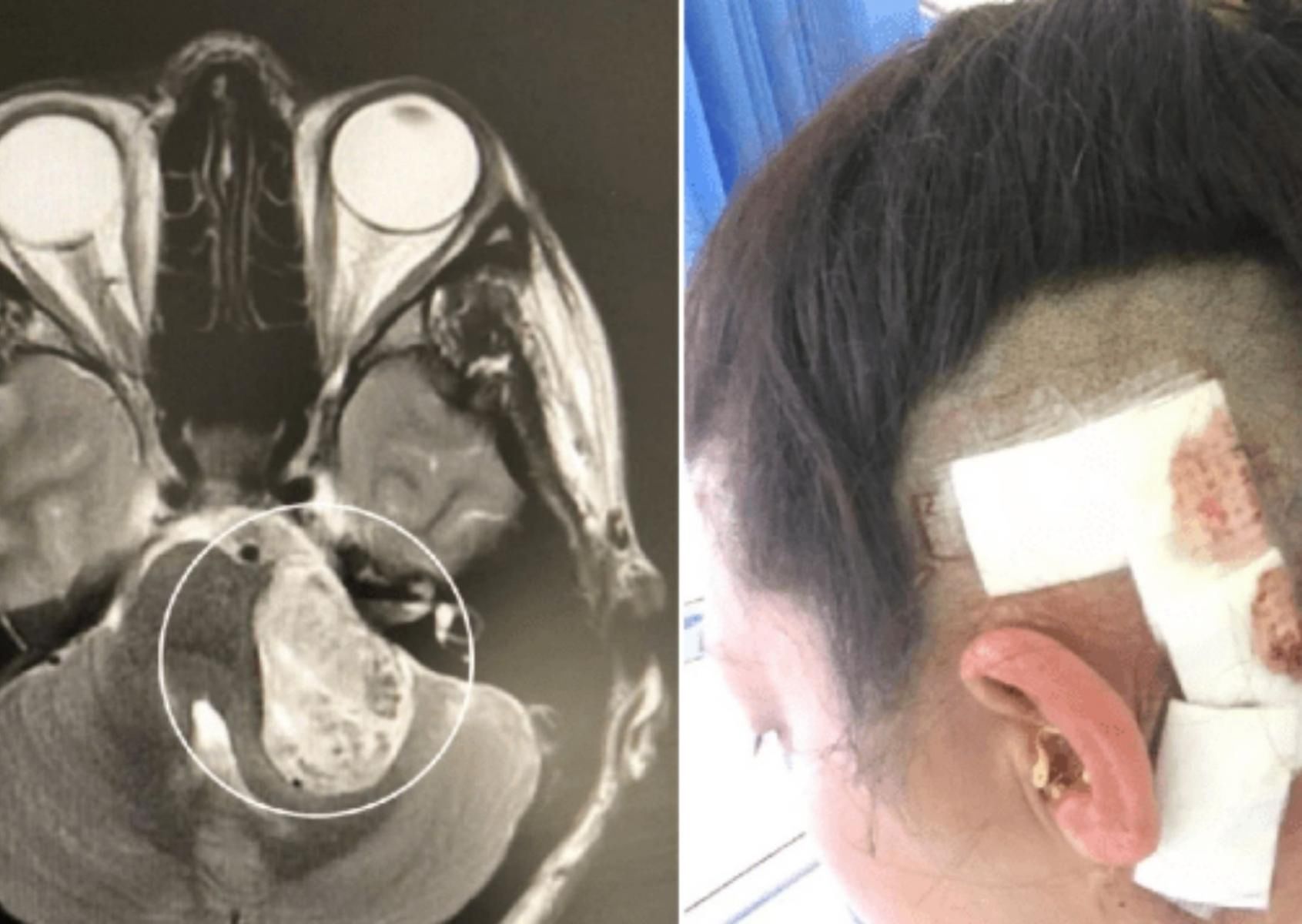 Kobieta była przekonana, że cierpi na zaburzenia lękowe. Okazało się, że miała guza mózgu