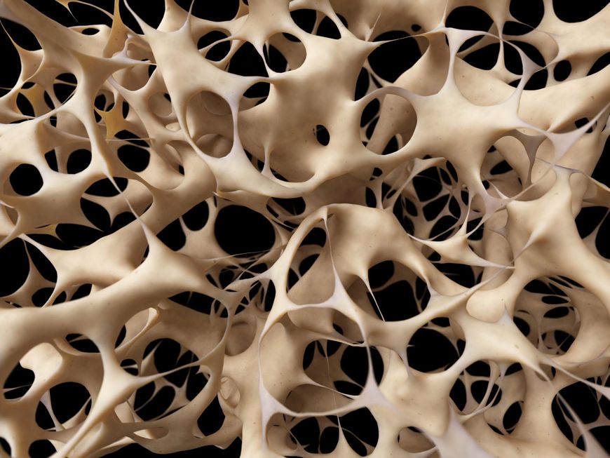 Osteoporoza to choroba, charakteryzująca się małą gęstością kości