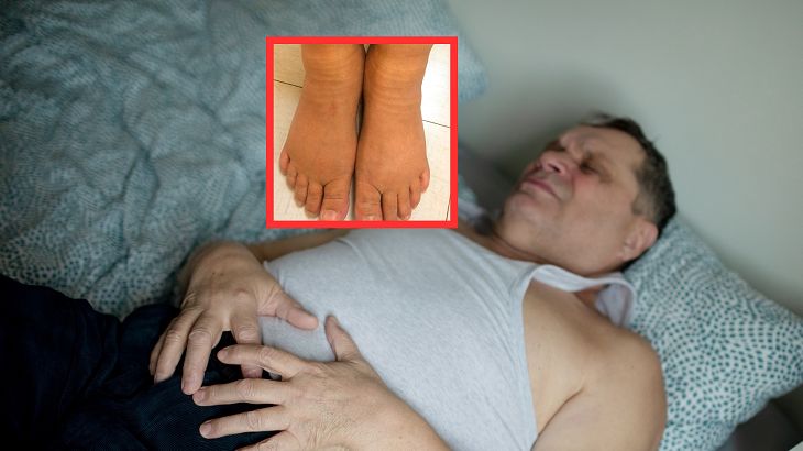 Już 9 mln Polaków cierpi na niealkoholowe stłuszczenie wątroby