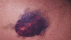 Maść na stłuczenia - czym są stłuczenia, maść z heparyną, maść z nagietkiem, arnikowa