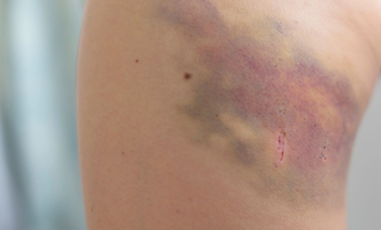 Obrażenia tkanek miękkich – przyczyny, objawy, leczenie